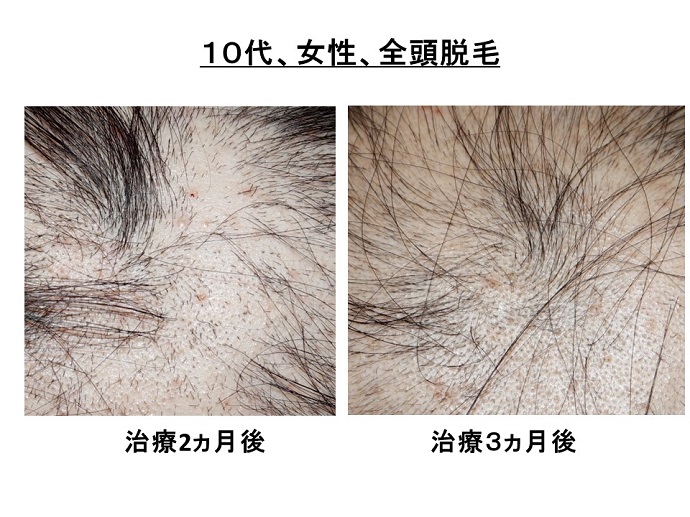 円形脱毛症　病院